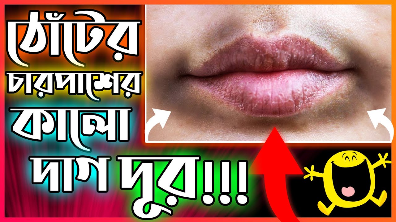 ✅ ঠোঁটের চারপাশের কালো দাগ দূর করার উপায় | How To Remove Dark Patches Around Mouth in Bangla