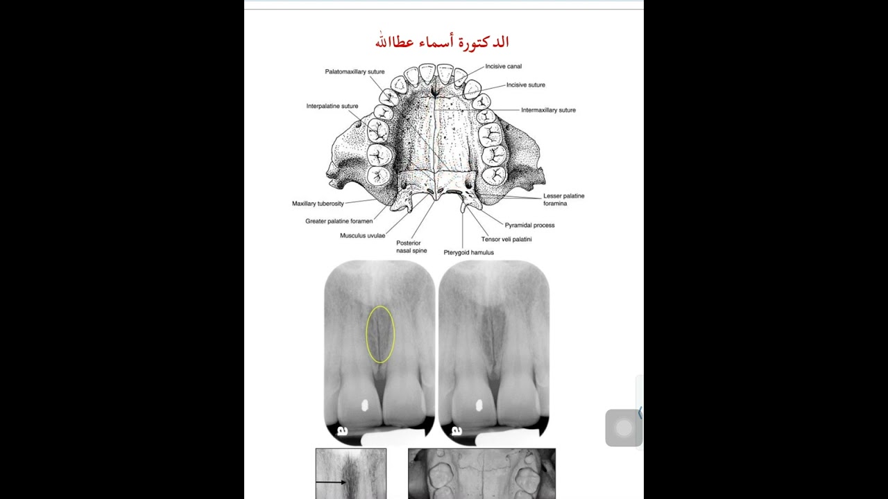 Landmarks of maxillary in dental radiographs part 3 /المعالم التشريحية للفك العلويّ على الأشعة 