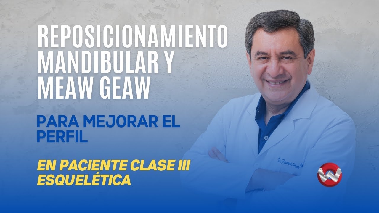 Reposicionamiento mandibular y MEAW - GEAW para mejorar el perfil en clase III esquelética