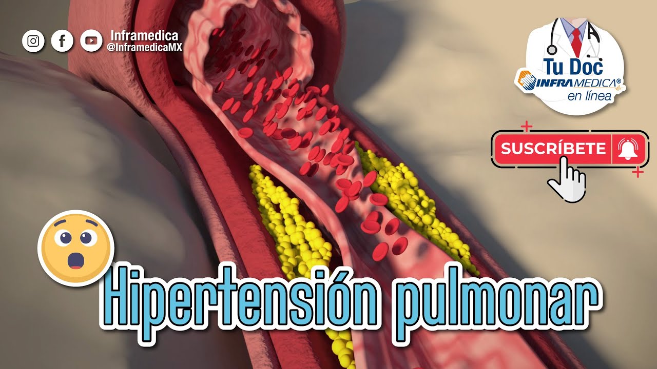 😲 ¿Hipertension Pulmonar? 👨🏻‍⚕️☝🏻