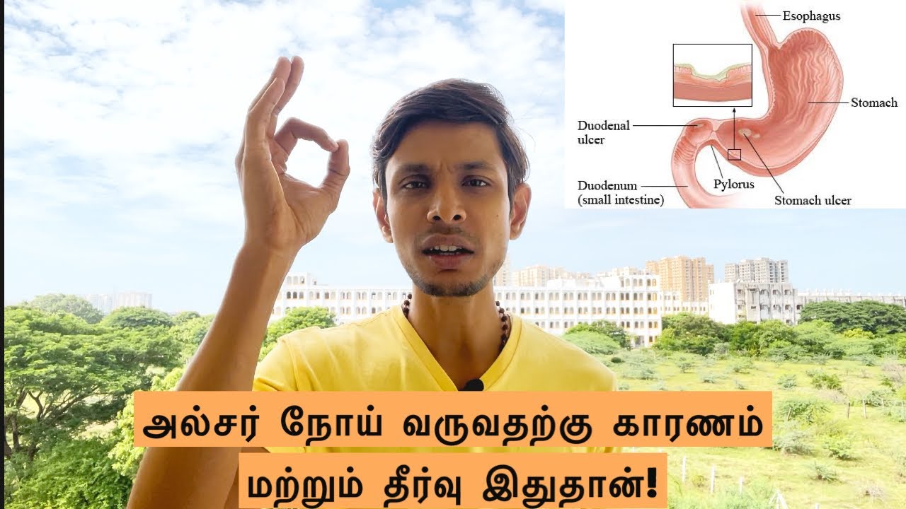 Main reason for ulcers | CAUSE AND CURE | Sundar JC