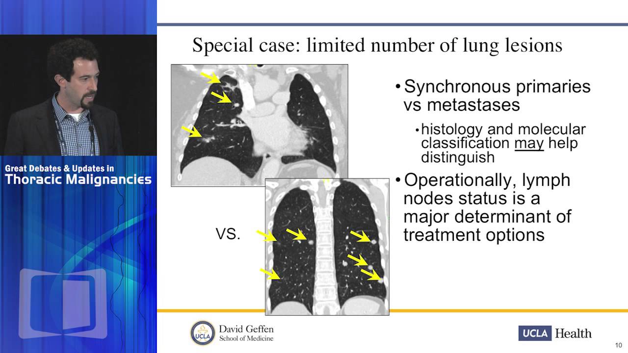Oligometastatic NSCLC