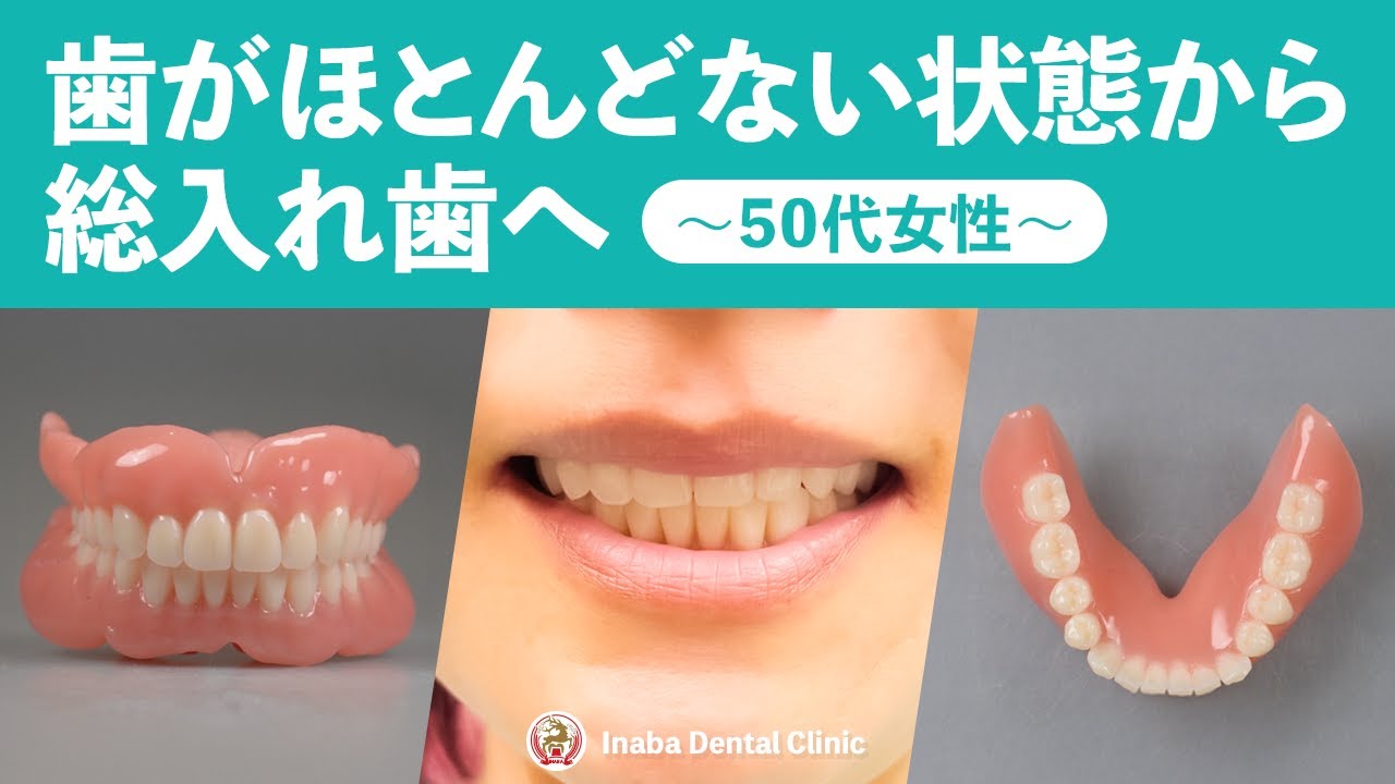 歯がほとんどない状態から総入れ歯へ〜50代女性〜