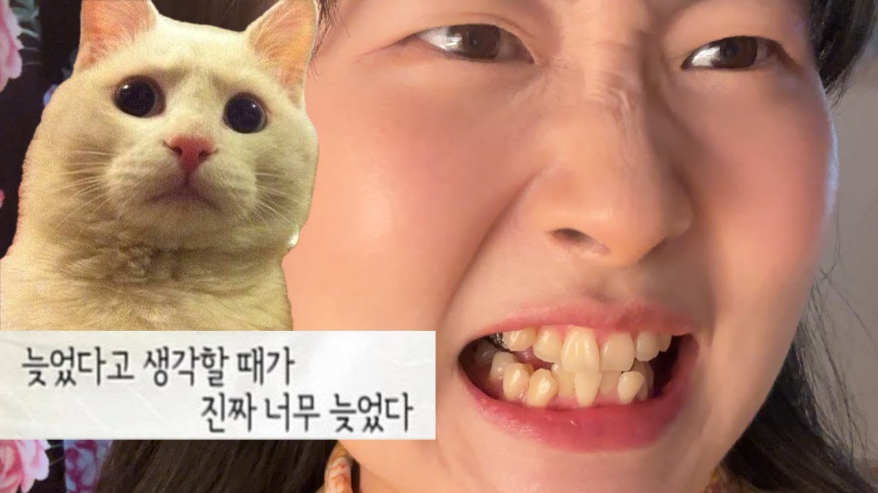 30살 교정, 악궁확장 비발치 덧니 1년 변화