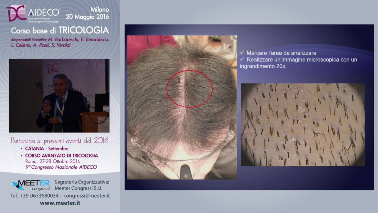 A. Rossi - Tricoscopia: lesioni del cuoio capelluto e alterazioni del fusto del capello