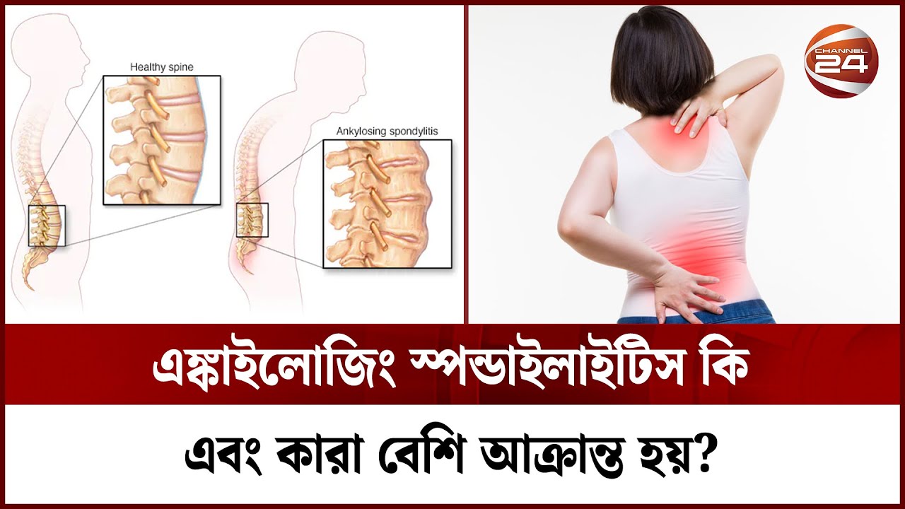 চিকিৎসায় এঙ্কাইলোজিং স্পন্ডাইলাইটিস কি সম্পূর্ণ নিরাময়যোগ্য? | Ankylosing spondylitis | Channel 24