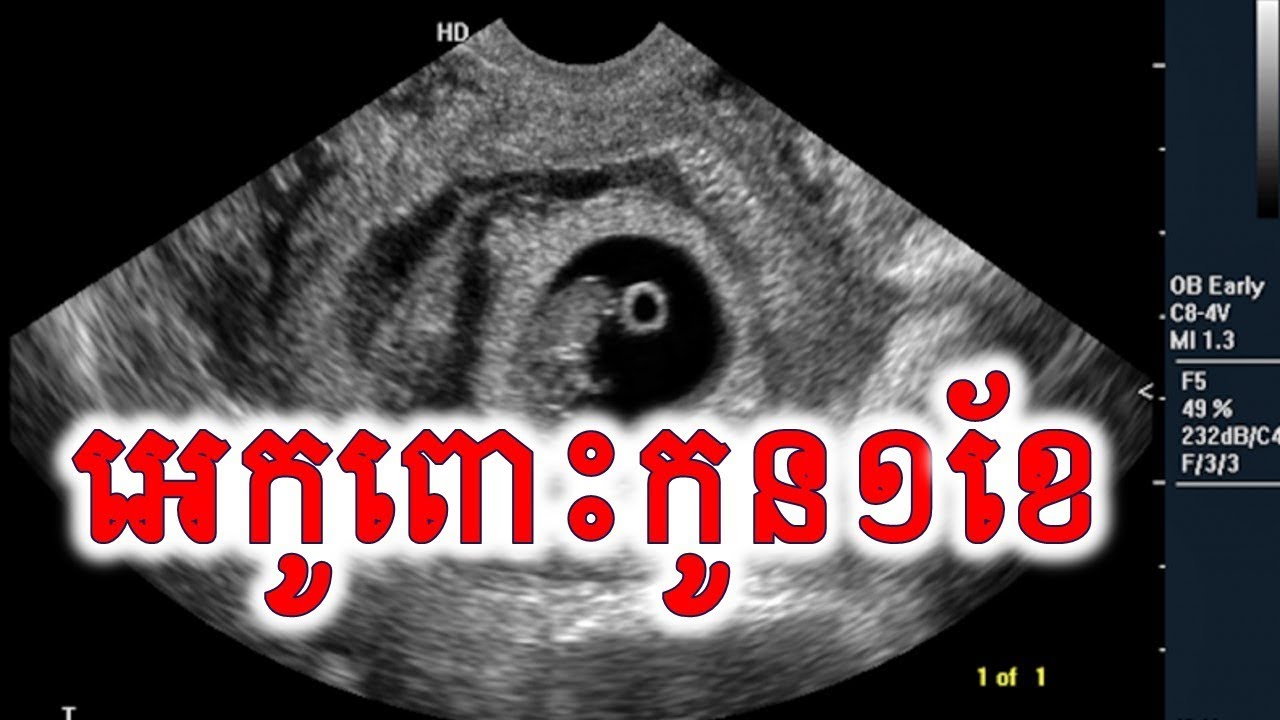 អេកូផ្ទៃពោះ៤ទៅ៦អាទិត្យ ultrasound 4-6 week pregnancy by Dr Som
