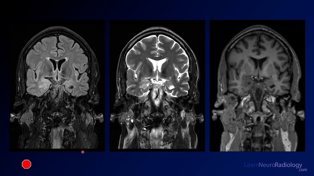 Neuroradiology Board Review - Brain Tumors - Case 13