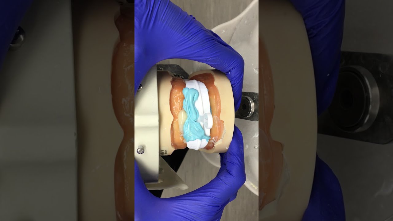 Fabrication of a provisional restoration with Bis-acryl resin.