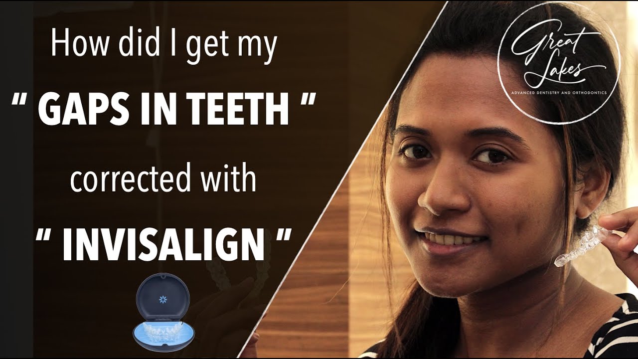 Gaps or Spacing in Teeth Corrected with Invisalign | Midline Diastema |  Invisible Clear Aligner