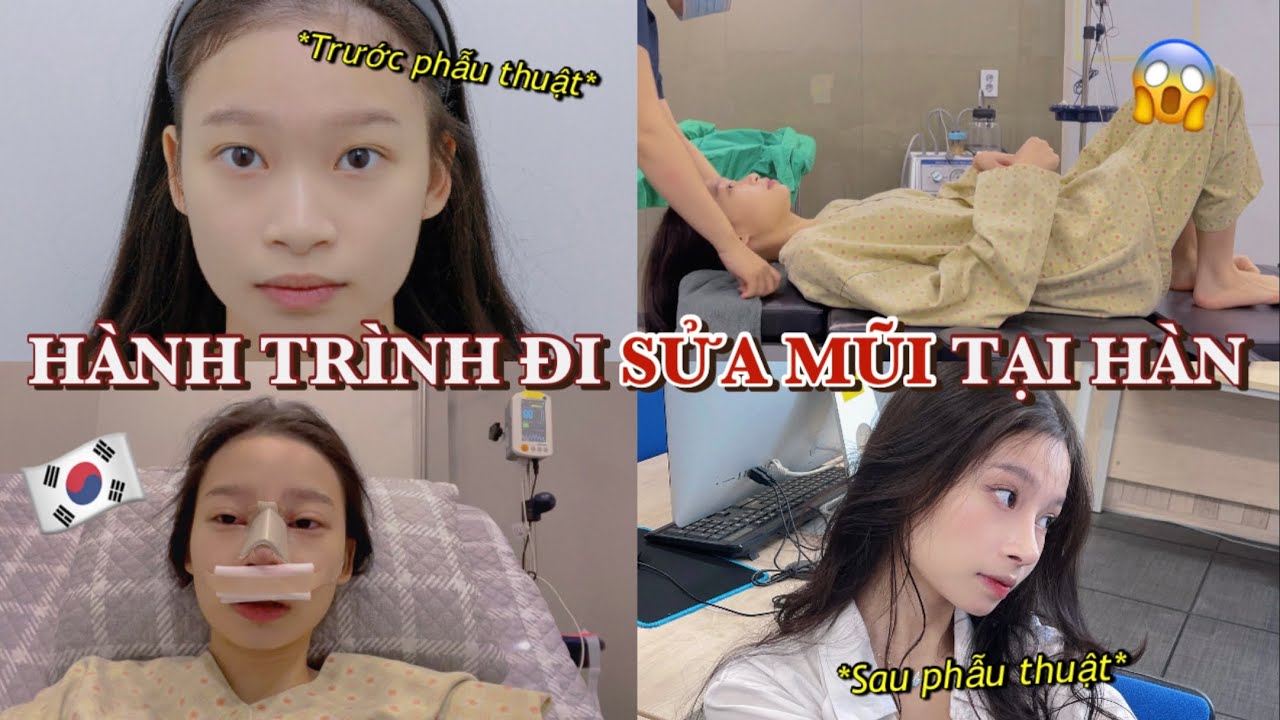 YOUNG KV ĐI SỬA MŨI?! NHẬT KÍ ĐI SỬA MŨI CỦA MÌNH🇰🇷🥰