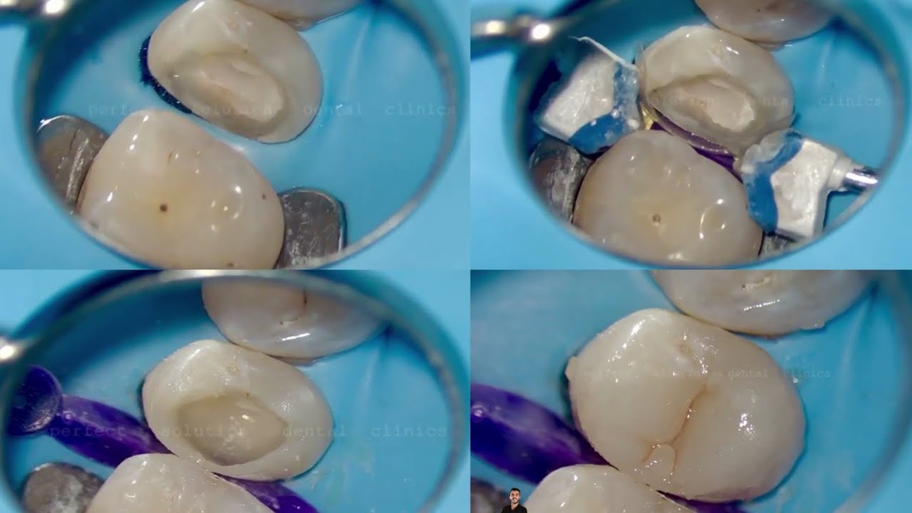 build up Class II Composite restoration for premolar