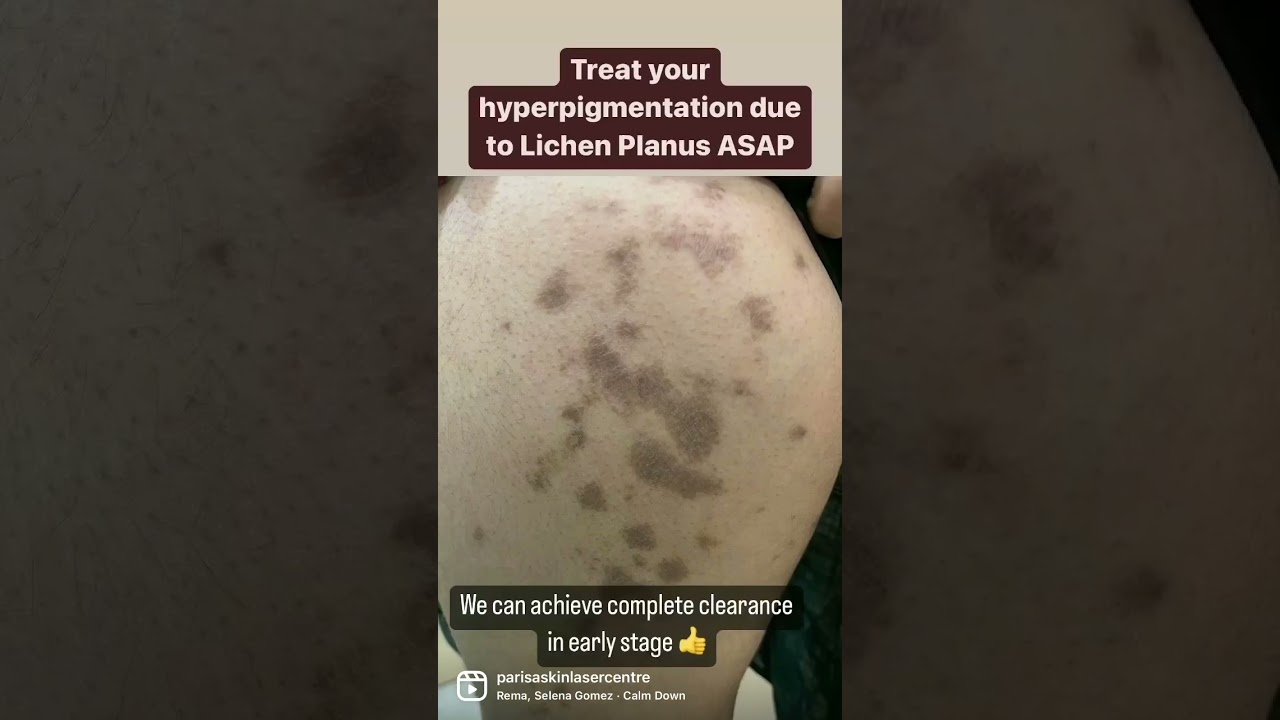 Lichen Planus Treatment in Chandigarh #shorts #youtubeshorts