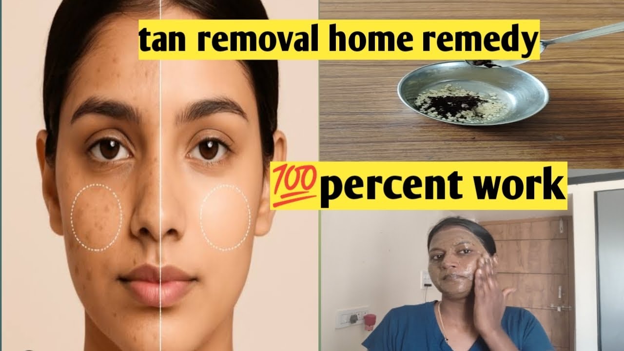 ವೈಟ್ ಹೆಡ್ಸ್ ಬ್ಲಾಕೆಡ್ಸ್ ಸ್ಟಾಂಡ್ ರಿಮೋವ್ whiteheads blackheads home remedy
