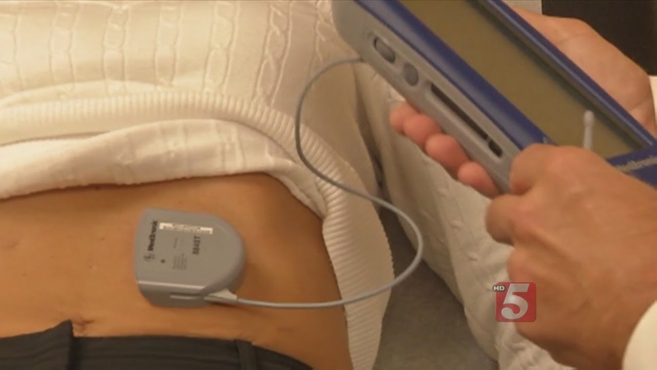 Gastric Pacemaker To The Rescue