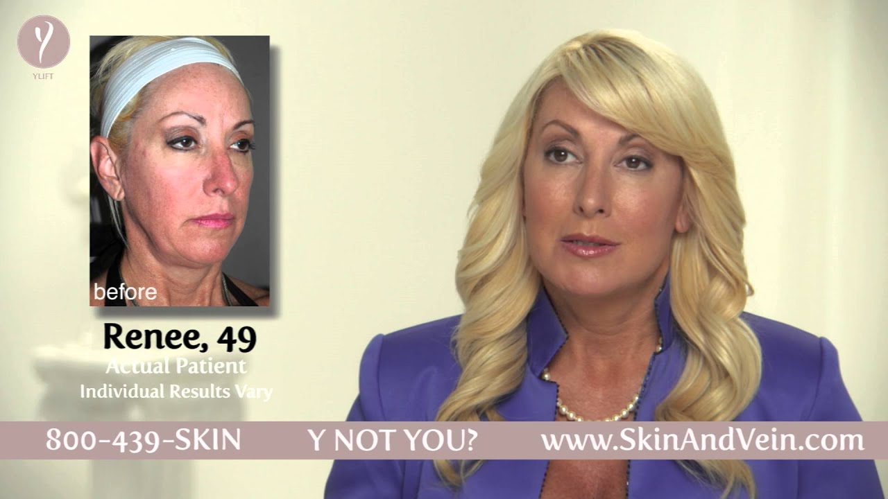 All About the Non-Surgical Y-Lift Procedure | The Skin & Vein Center
