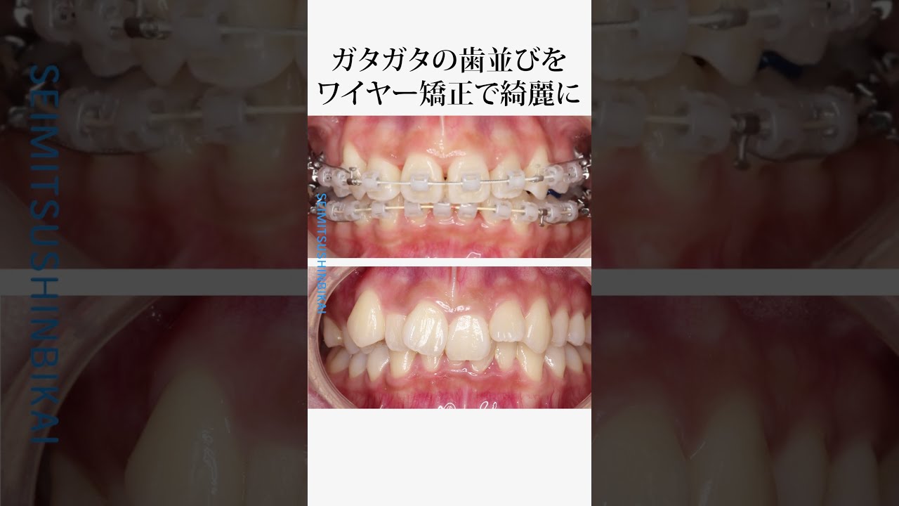 【20代女性】ガタガタの歯並びをワイヤー矯正で綺麗に #歯 #歯科医院 #歯医者 #症例 #インビザライン #マウスピース矯正 #矯正歯科 #ワイヤー矯正
