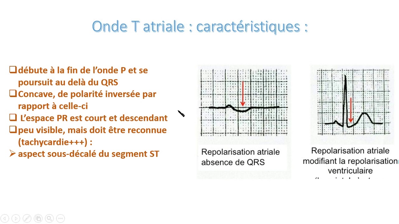 Ondes T de repolarisation auriculaire ou Sus/sous d&eacute;calage du segment ST ?