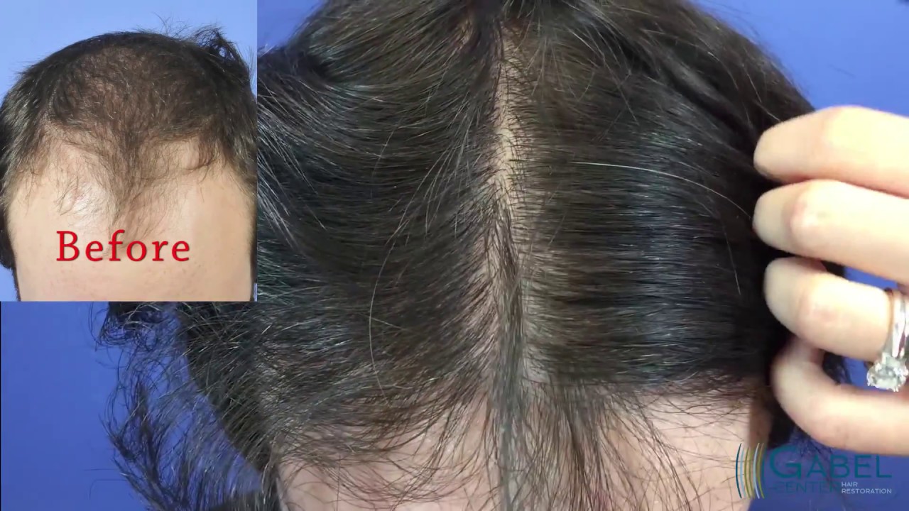 Dr Steven Gabel Hair Transplant   3655 Grafts