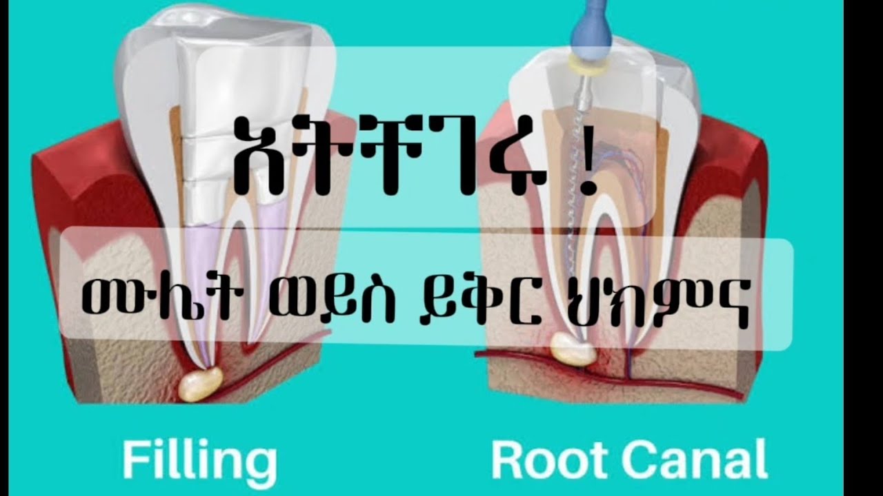 ለመምረጥ የተቸገራችሁት የጥርስስር ህክምና ወይስ ሙሌት