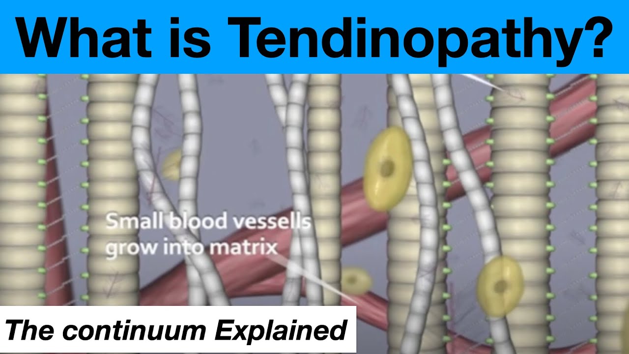 The Tendinopathy Tendon Tendonitis Continuum Theory Explained
