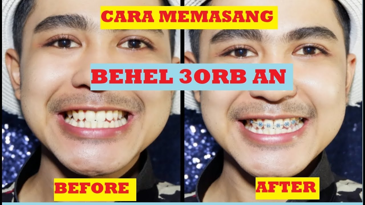 CARA MEMASANG BEHEL 30rb an (behel fashion lepas pasang)