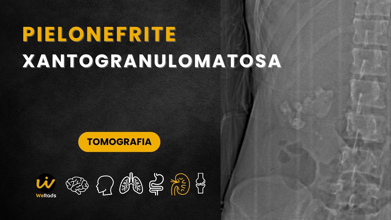 Pielonefrite Xantogranulomatosa