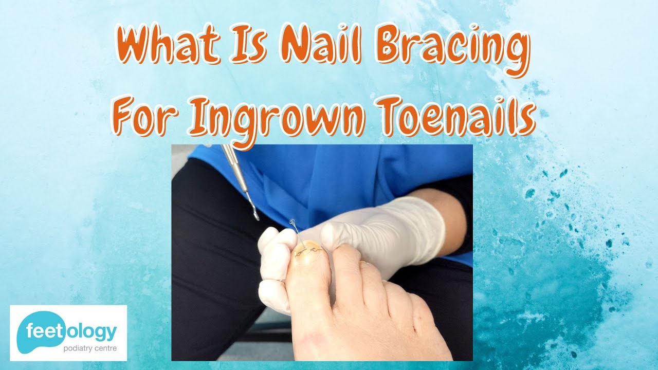 What Is Nail Bracing For Ingrown Toenails?