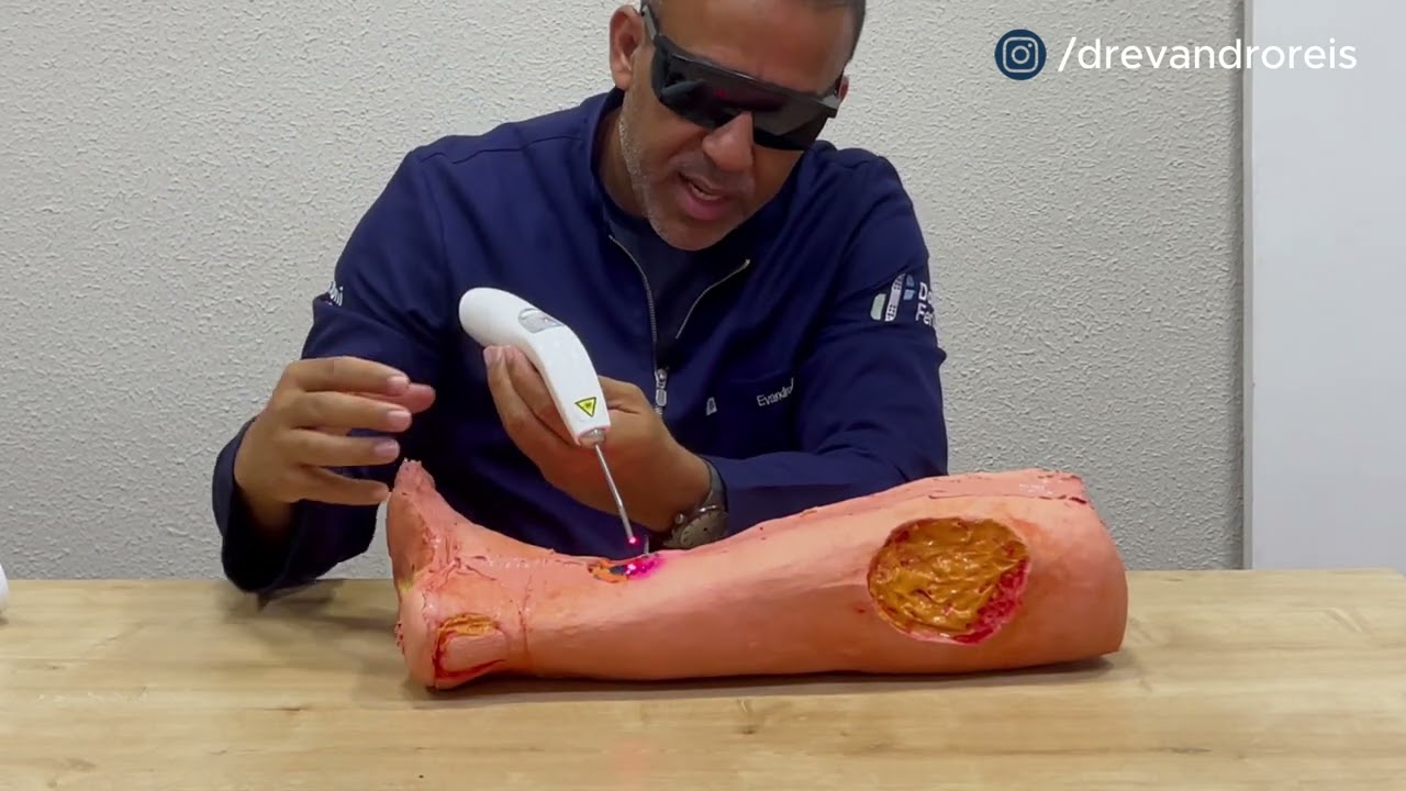 Mitos e Verdades Sobre Laserterapia no Tratamento de Feridas | Dr. Evandro Reis