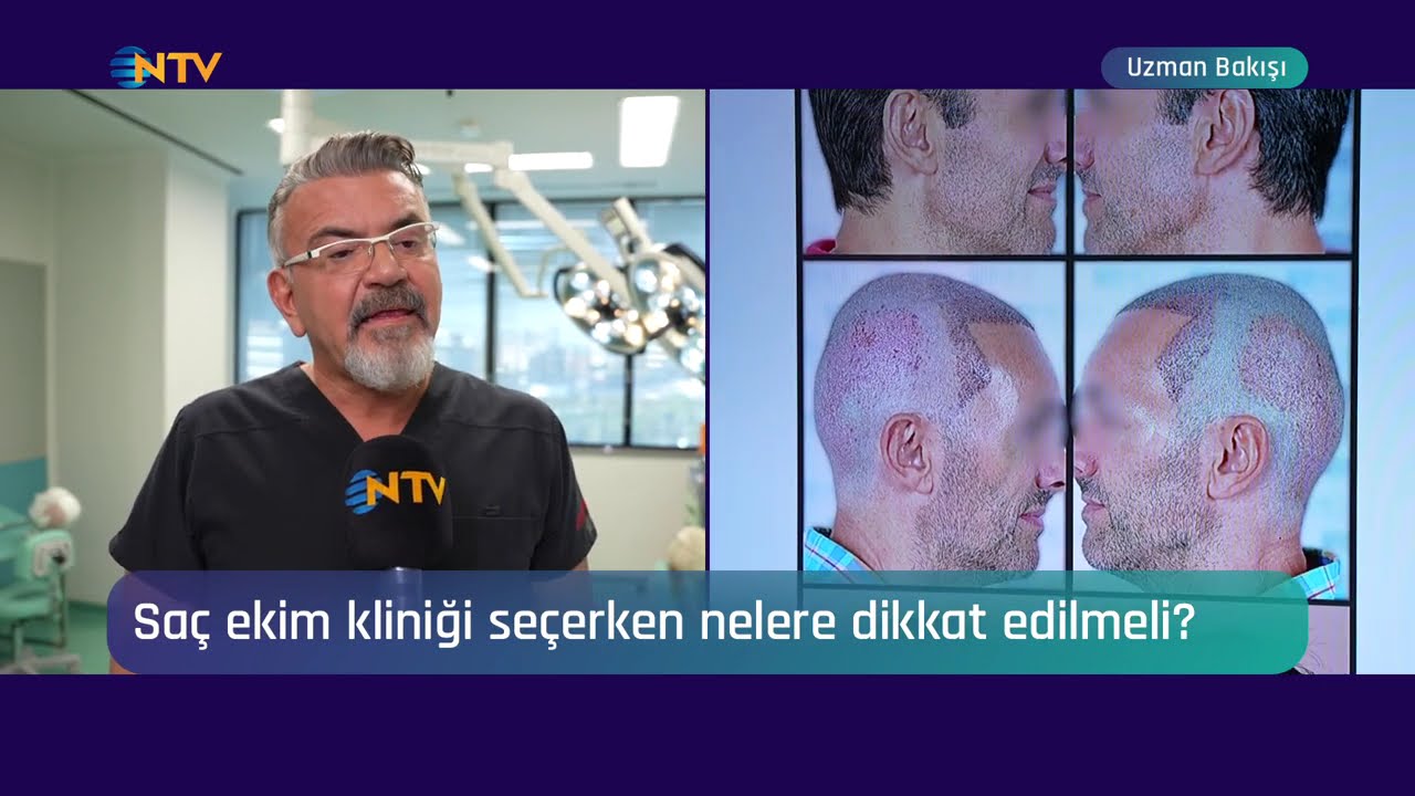 Saç Ekimi Kliniği Seçerken Nelere Dikkat Edilmelidir? #hairtransplant #asmed #korayerdogan #ntv