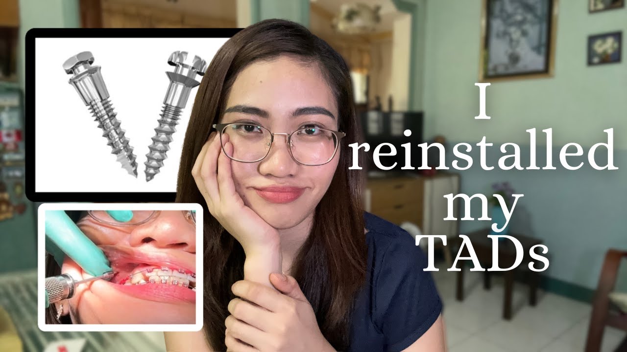 September Braces Update (Part9/12) | TADs reinstalled