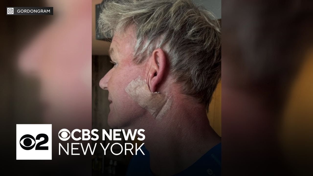 Celebrity chef Gordon Ramsay announces skin cancer diagnosis