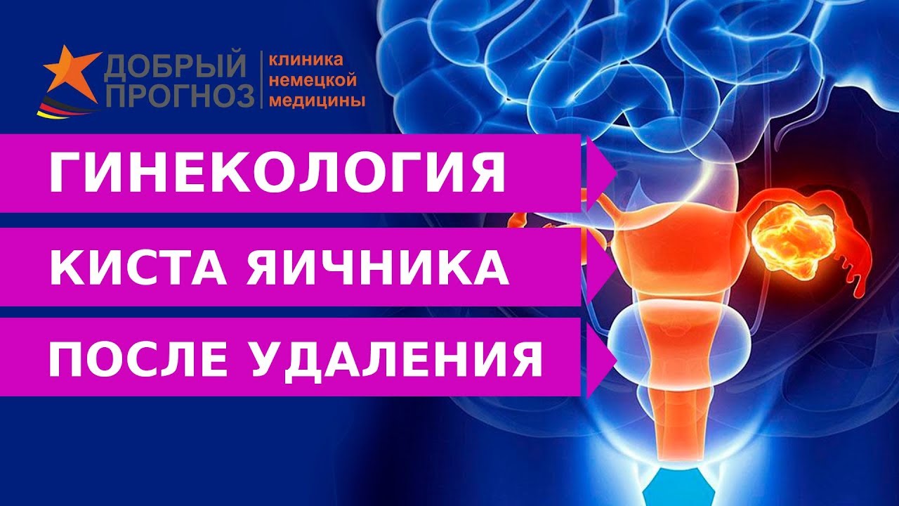 Что делать после УДАЛЕНИЯ КИСТЫ ЯИЧНИКА?