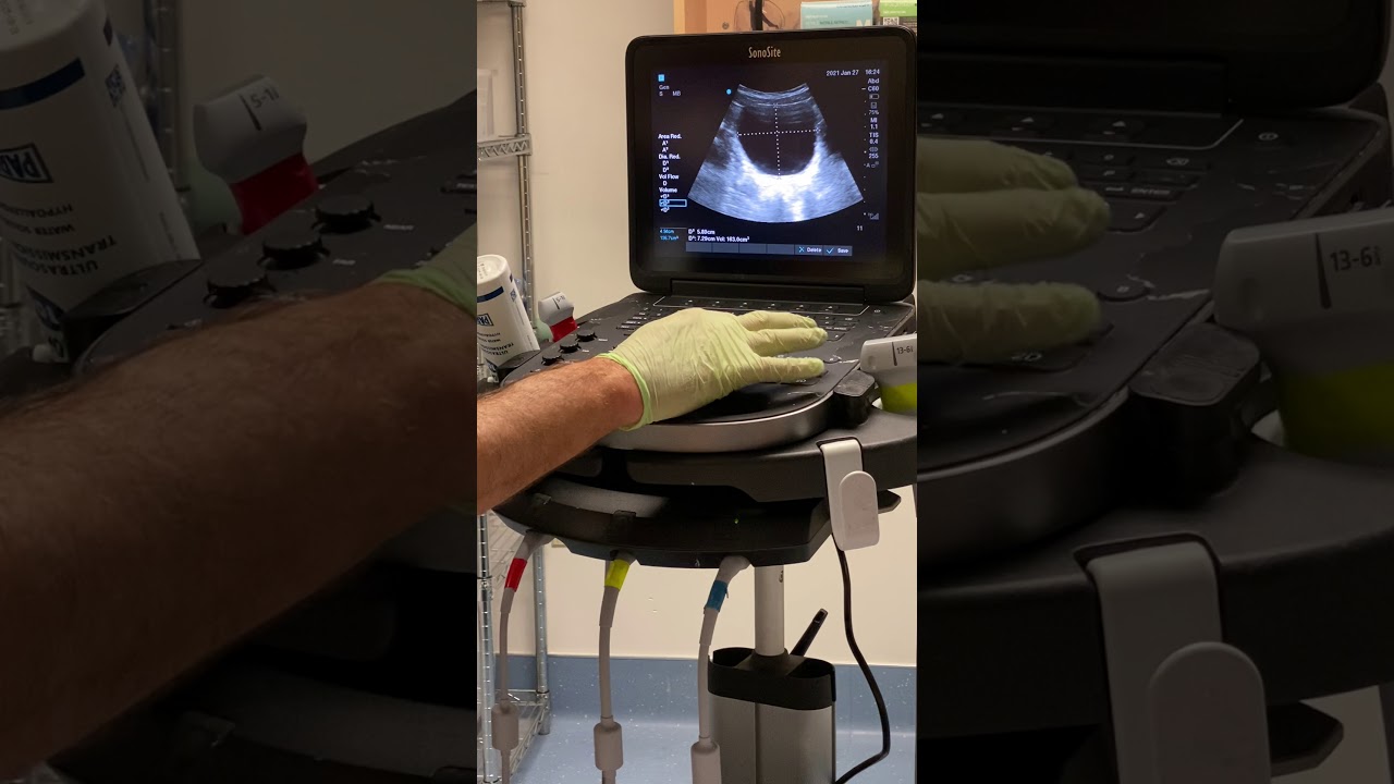 Bladder Scan  Procedure