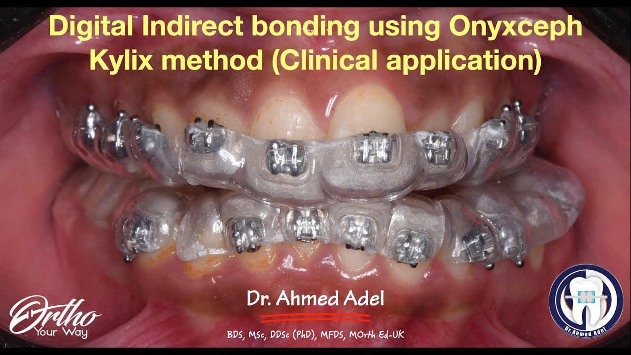 Digital indirect bonding of braces / brackets using onxyceph kylix method (clinical application)