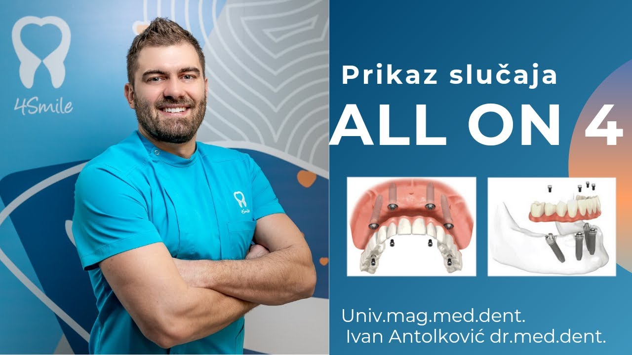 ALL ON 4 - tretman za BEZUBU ČELJUST - Dental Centar 4Smile. - Stomatolog Zagreb