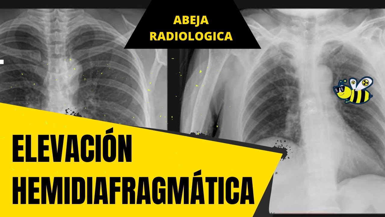 ⚠️🟡➡️ Elevación  Hemidiafragmática ⚠️🟡➡️