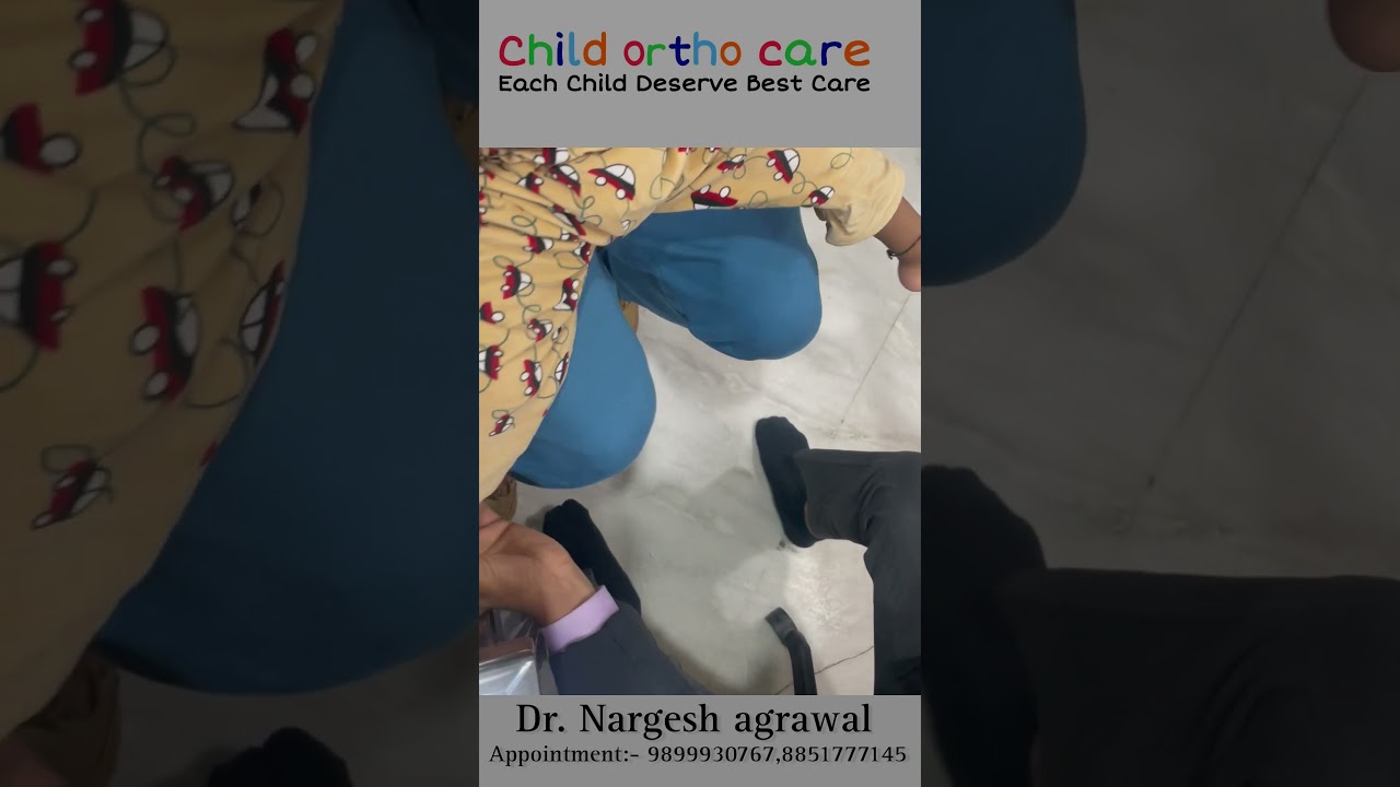 Clubfoot child walk and run like normal child #clubfoottreatment #टेडेमेडेपाँव #ctev #childorthocare