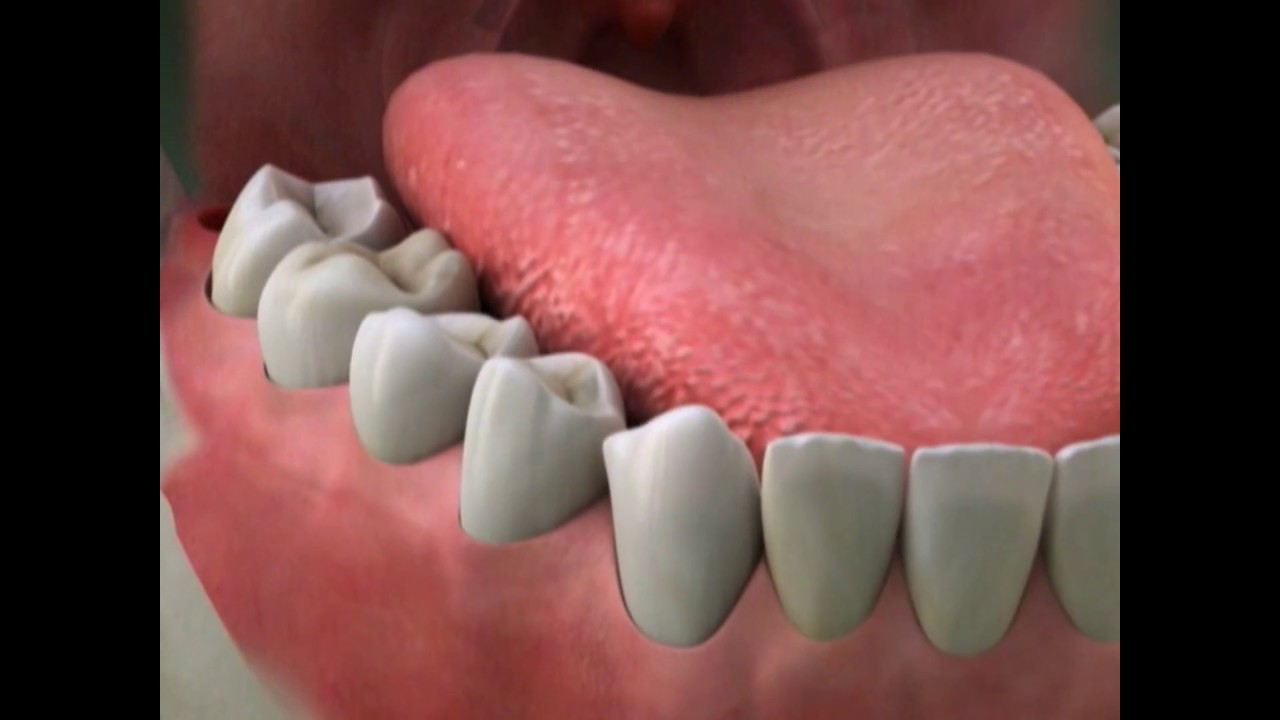 Dry Socket | Lake Merritt Dental, Oakland, CA