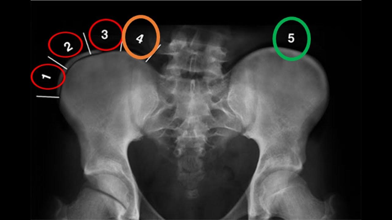 Mi hijo tiene escoliosis, ¿qué es eso del Risser?
