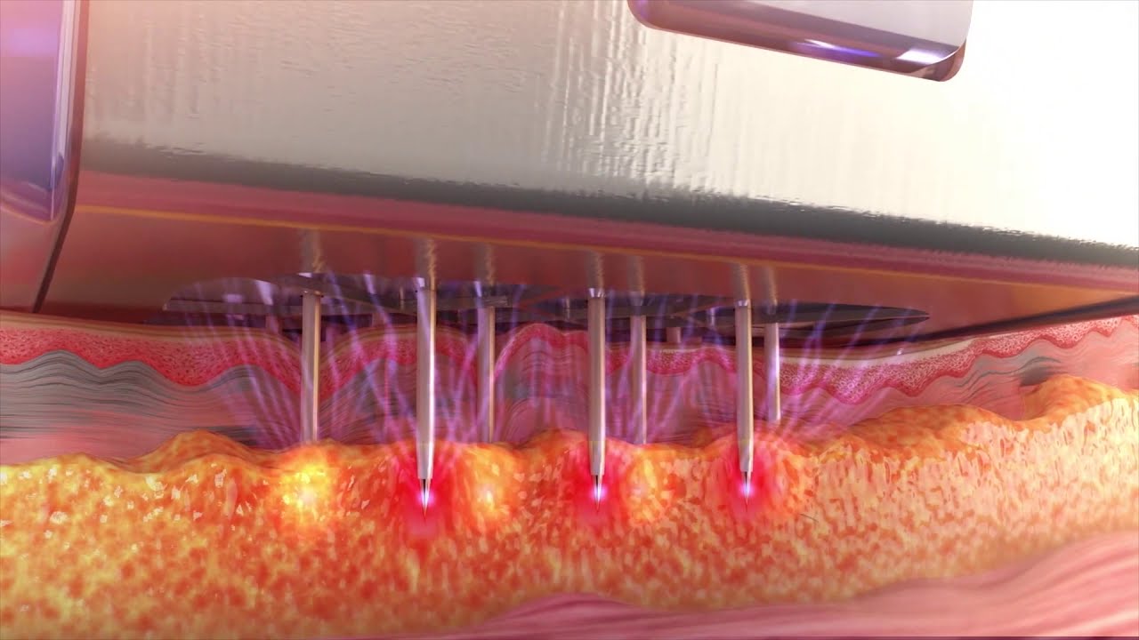How Does RF Microneedling Work?