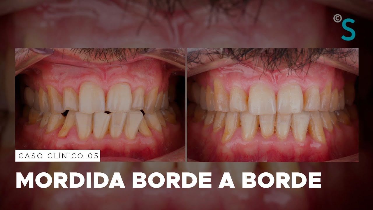 Mordida borde a borde · Clase III y Apiñamiento · Caso clínico de Ortodoncia