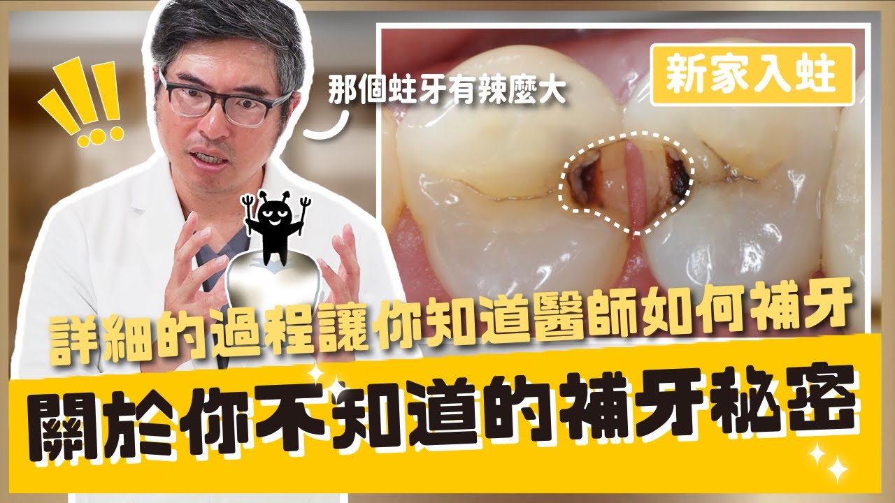 【美學修復#5】補牙是什麼？什麼情況可以樹脂補牙？什麼時候做假牙、瓷塊？【醫師說重點】｜【祐民牙醫－隱適美旗艦店】鑽石級楊大為醫師 #補牙 #瓷塊 #假牙 #隱適美