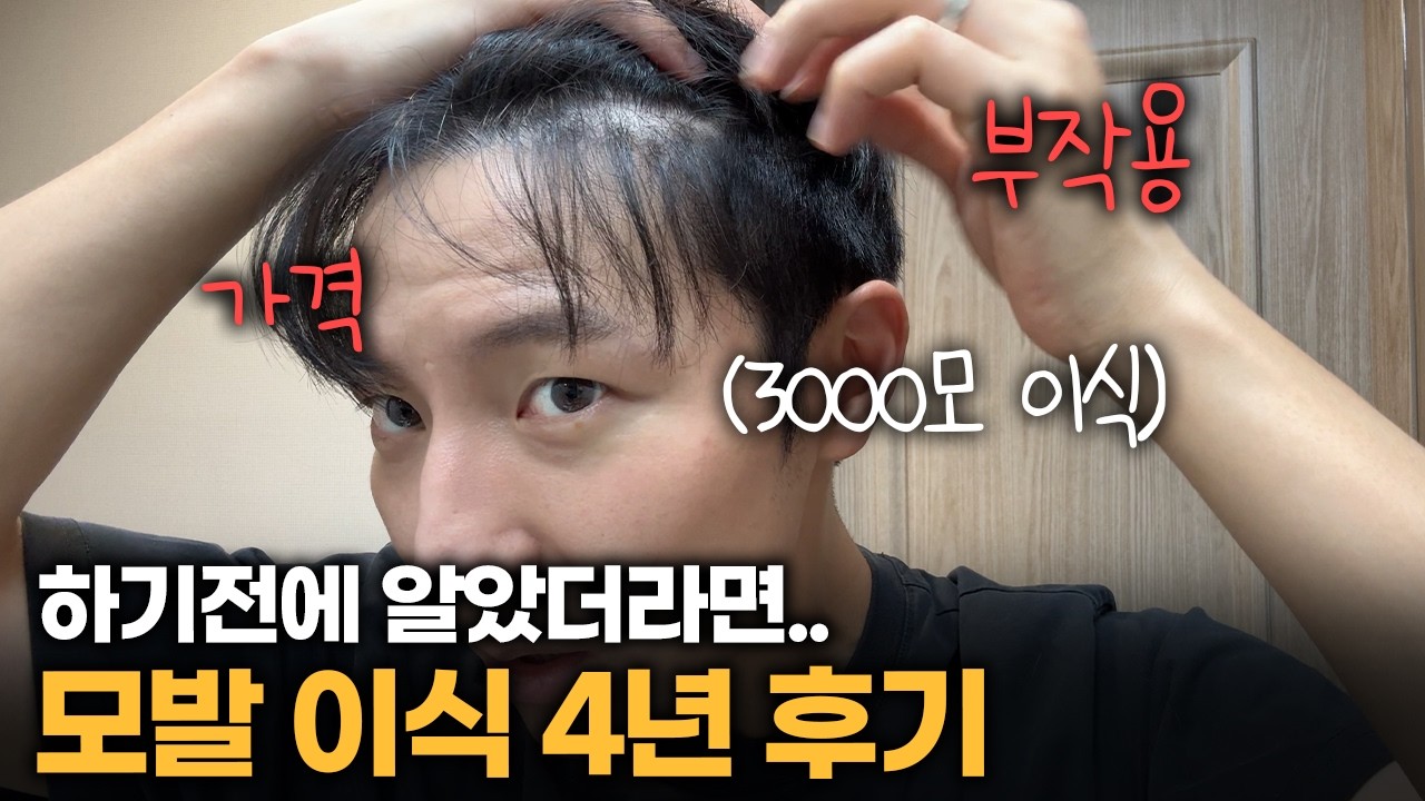 모발 이식 4년 후.. 후기, 부작용, 가격 싹 다 알려드립니다.