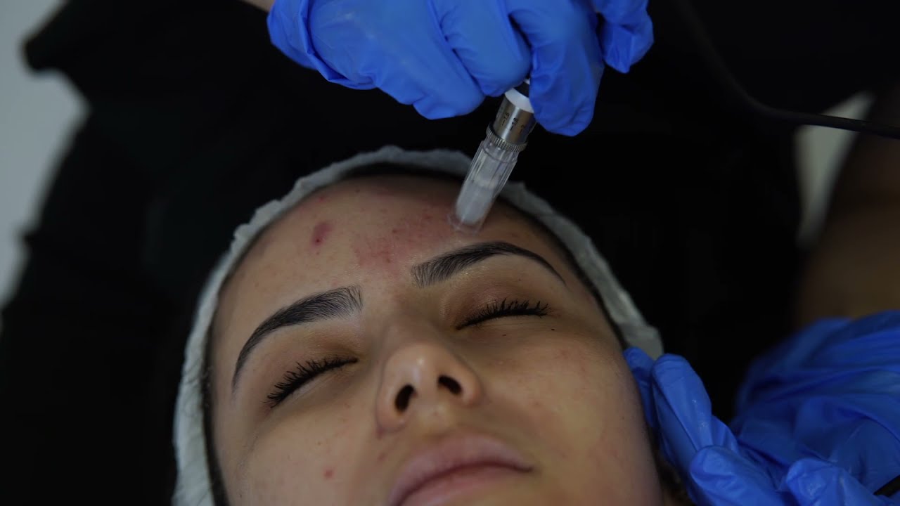 Microneedling (collagen Induction Therapy)