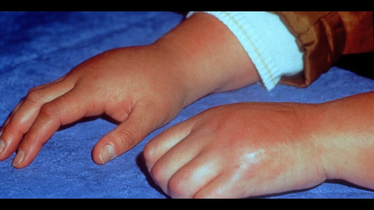 Learn About Reflex Sympathetic Dystrophy - Also Known as Reflex Pain