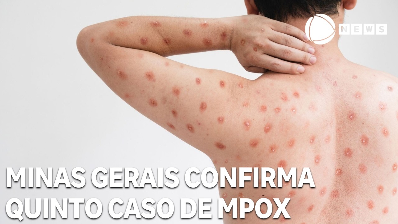 Minas Gerais confirma quinto caso de Mpox; Brasil já soma 88 infecções em 2026