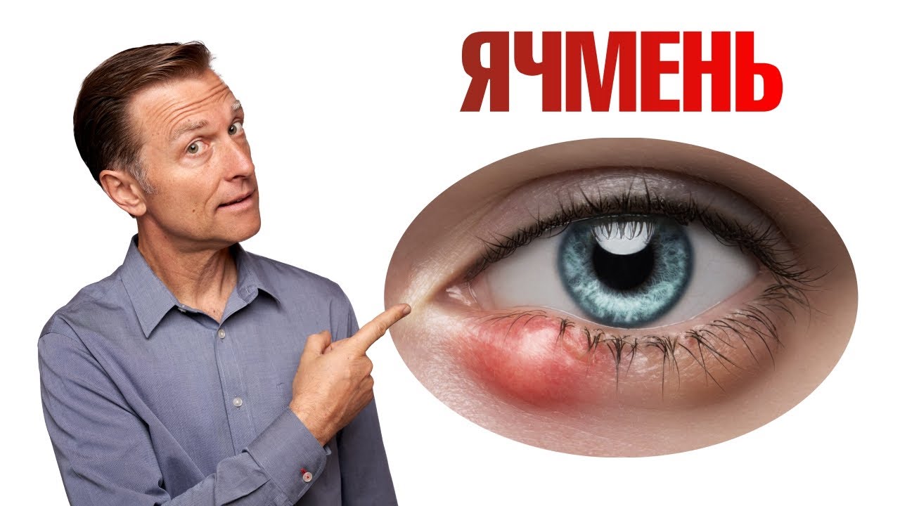 Как избавиться от ячменя на глазу раз и навсегда?👁