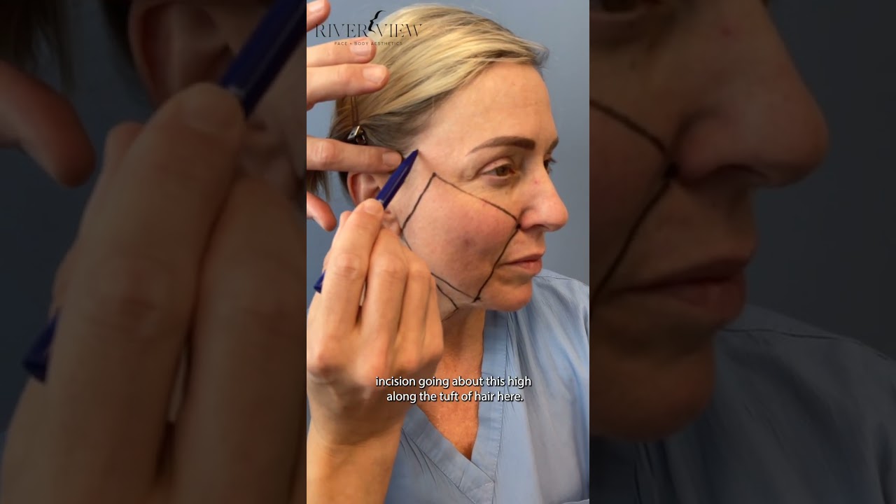 Dr. Daniel Schneider Performs Surgical Markings for a Facelift & Neck Lift