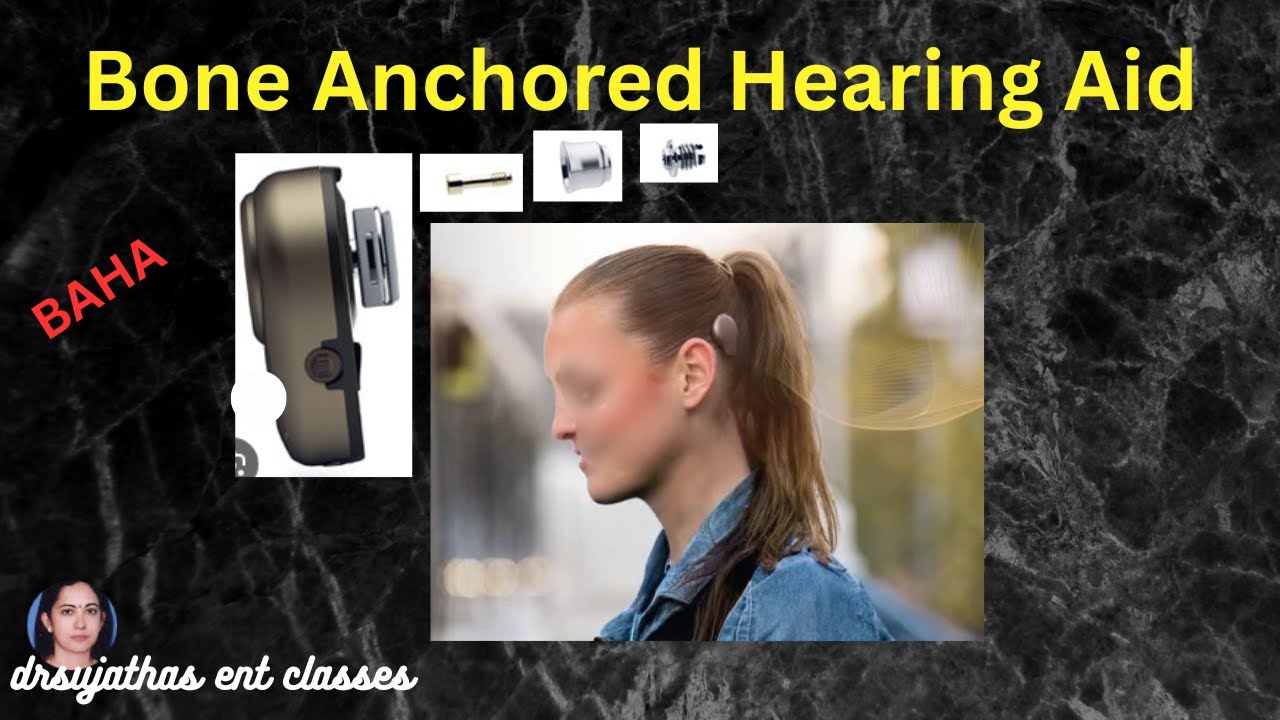 268.Bone Anchored Hearing Aid (BAHA) |Indications,Working, Surgery&Benefits|ENT Lecture by DrSujatha